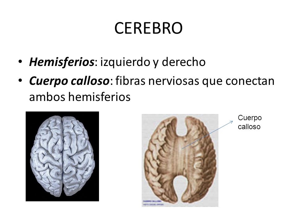 cuerpo calloso cromosoma 13 anillo de cuerpo calloso cromosoma 13 anillo de